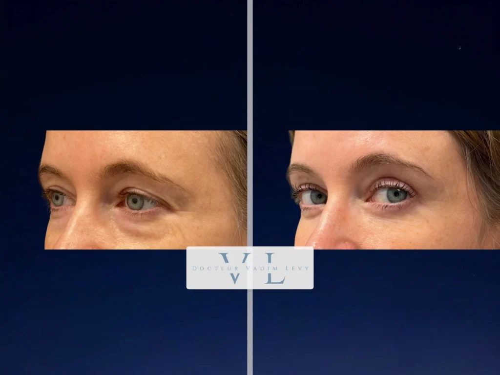 Avant après - résultat naturel d’une Chirurgie des Paupières avec lipofilling